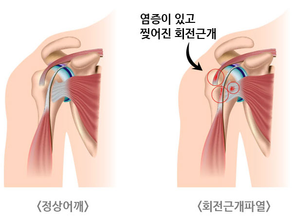 모커리한방병원 정상어깨 / 회전근개파열